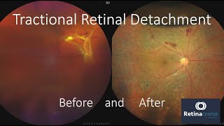 🆘Tractional Retinal Detachment due Diabetes  Before and After Vitrectomy  Dr Aureliano Moreno [upl. by Ylloj]