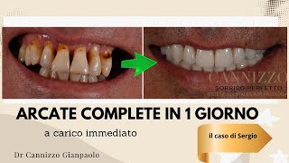 Un caso di implantologia dentale risolto con successo  Studio Dentistico Cannizzo [upl. by Artkele467]