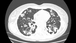 STR Cardiothoracic Case Webinar 10212021 [upl. by Naujad828]