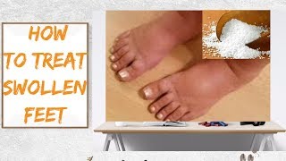 Swollen feet Effective remedies to treat swollen feet at home [upl. by Arundell]