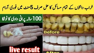 Top 4 Home Remedies For Tooth Cavity Teeth whitening in just 2 minutes  Remedy For Teeth Cavity [upl. by Eissirhc538]