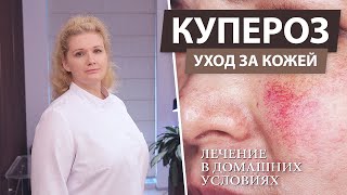 Лечение купероза на лице в домашних условиях Купероз  что это [upl. by Sidonnie]