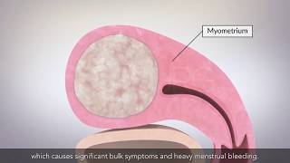 Laparoscopic myomectomy [upl. by Hoeg]