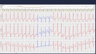 wwwecgepmcom Caso 01 de Holter  TV incessante [upl. by Calisa421]