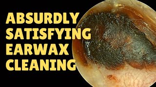 ABSURDLY Satisfying Earwax Cleaning [upl. by Ainotal]