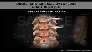 Anterior Cervical Discectomy amp Fusion at C34 C45 amp C56 [upl. by Aneehsak]