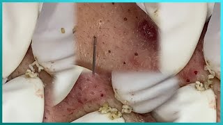 Big Cystic Acne Blackheads Extraction Blackheads amp Milia Whiteheads Removal Pimple Popping [upl. by Atekihc661]