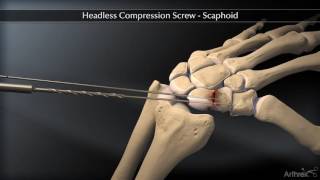 Headless Compression Screw – Scaphoid [upl. by Hsiekal]