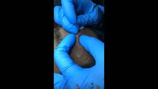 VERY BIG CYSTIC ACNE  BIG ACNE REMOVAL ON THE FACE 5 [upl. by Marron]