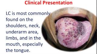 10 MIN REVISION Lymphangioma Circumscriptum [upl. by Wivinia]