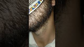 Carly hair increasing Carly hair problem beard hairstyle 181viralshortsatisfying [upl. by Rayner]