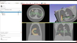 Create DICOM files from CT volume and segmentation [upl. by Arrehs257]