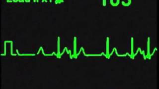 Atrial Trigeminy  ECG Simulator  Arrhythmia Simulator [upl. by Vershen]