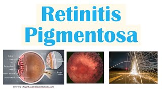 Retinitis Pigmentosa  Genetics Pathophysiology Signs amp Symptoms Diagnosis Treatment [upl. by Pearlstein935]