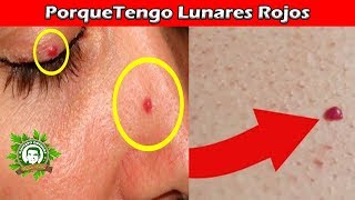 Porque Tengo Lunares Rojos En La Piel a Qué Se Deben y Como Poder Quitarlos Con Este Genial Remedio [upl. by Imhskal]