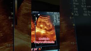 Multiple nephrolithiasis ultrasound showing video  kidney stones ultrasound ultrasound pregnant [upl. by Odiug]