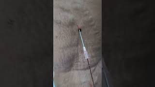 Varicose Veins treatment by Dr Hussain at Hussaingreekcliniccom without surgery drhussain [upl. by Nylorak]