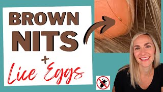 Brown Nits and Lice Eggs What it Means [upl. by Pyszka923]