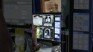 pulmonary angiography filming [upl. by Areehs]