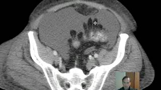 CT Epiploic Appendages Discussion [upl. by Marten539]