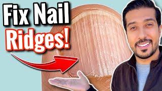 Vertical Ridges on Nails  What Are Your NAILS Trying to Say [upl. by Gravante511]