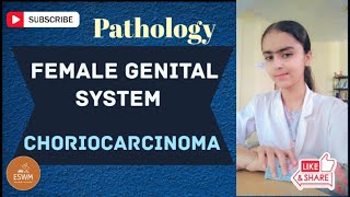 What Is CHORIOCARCINOMA In Pathology [upl. by Notserc]