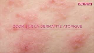 Tout Savoir sur la Dermatite Atopique [upl. by Aurita751]