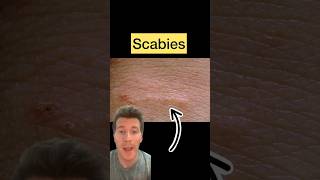 Doctor explains SCABIES in 60 seconds  causes symptoms treatment shorts scabies health [upl. by Bowne905]