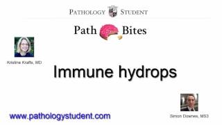 Path Bites Immune Hydrops [upl. by Eutnoj]