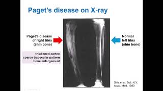 What is Paget’s Disease of Bone and how does bisphosphonate treatment work Dr Daroszewska explains [upl. by Stoat]