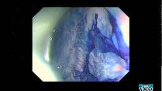 Endoscopy of Aberrant Crypt Foci The Expert Approach [upl. by Irreg]