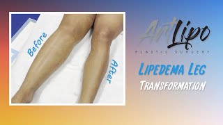 Cankles amp Knees Liposuction  Lipedema Legs  Lipo 360°  Expert Dr Thomas Su [upl. by Purity]