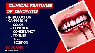 Clinical Features Of Gingivitis  Periodontology Lecture [upl. by Monarski667]