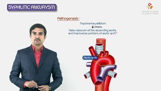 Syphilitic aneurysm  ascending aorta amp arch or aorta   Pathology Usmle step 1 Fmge and Neet Pg [upl. by Ueihttam]