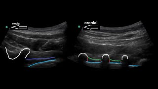 Paravertebral block [upl. by Faxan996]