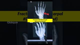 Fracture 5th Metacarpal ⚡️Xray Hand xray radiographerusn radiography shorts [upl. by Ahk]