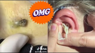 Blackhead Popping Extravaganza Satisfying Skin Care Moments [upl. by Ilatfan]