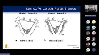 Indications Neurogenic Claudication amp Lateral Recess Stenosis  Phil Fagan MD [upl. by Orest]