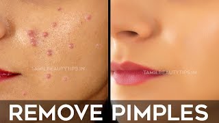 How to Remove Pimples Overnight  Pimple Remedy Beauty Tips in Tamil  Minmini [upl. by Hereld]