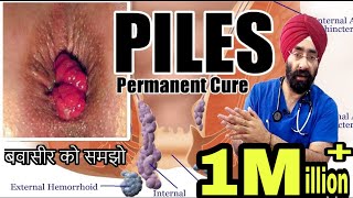 बवासीर  Piles  Hemorrhoids  समझो कारन से इलाज तक । १०० विज्ञान  हिंदी में ENG SUBTITLES [upl. by Laaspere]