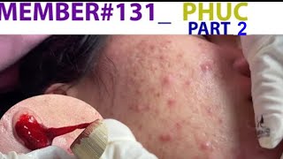 Acne Treatment Huong Da Nang 131 MEMBER Phuc Part 2 [upl. by Comfort]