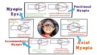 Myopia  Introduction and Etiology within 3 min 15 [upl. by Pell858]