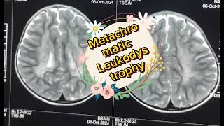 Metachromatic Leukodystrophy by DrMdOmar Faruk [upl. by Norag]