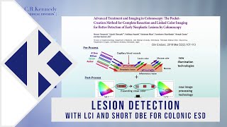 Lesion detection with LCI and Short DBE for colonic ESD with Professor Hironori Yamamoto [upl. by Suiradel]