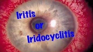 Medical Video Lecture Ophthalmology Iridocyclitis or Iritis Made simple [upl. by Arataj293]