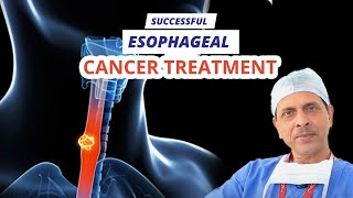 Esophageal Cancer Treatment Adult –Patient Version  Prof Dr Arvind Kumar [upl. by Fondea]