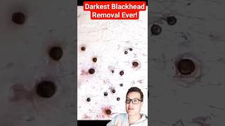 Darkest BLACKHEADS REMOVAL Ever shorts [upl. by Hyps]