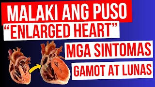 ENLARGED HEART  Lumalaki ang PUSO  Mga Sintomas Gamot at LUNAS  Cardiomegaly Heart Failure [upl. by Tolmach]