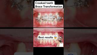 Crooked teeth braces dentist braces orthodontist dentalbraces allaboutbraces [upl. by Gabriell]