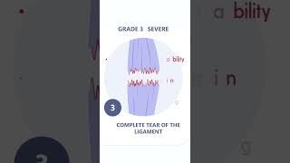 Ligament Injuries Simplified Grades of Severity and Their Impact sportsscience physiotherapy [upl. by Hannan]